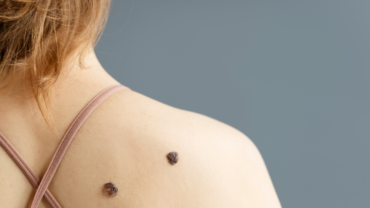 Warts, Skin tags & Mole Removal