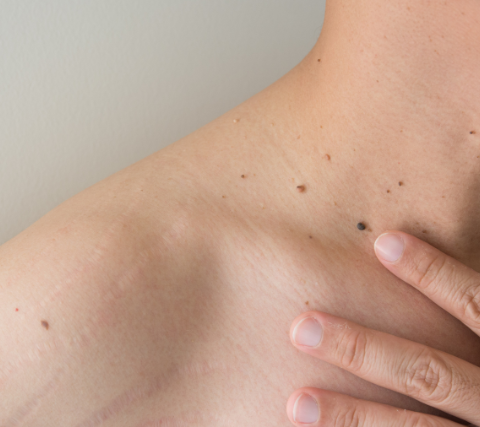 Warts vs. Moles: Which One Are You Dealing With?