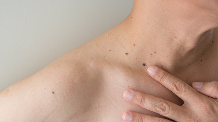 Warts vs. Moles: Which One Are You Dealing With?