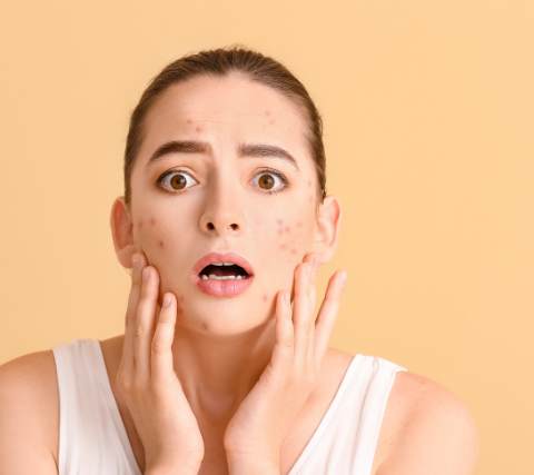 10 Everyday Skin Care Habits That Could Be Triggering Your Acne