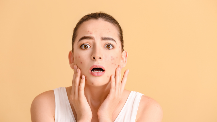 10 Everyday Skin Care Habits That Could Be Triggering Your Acne