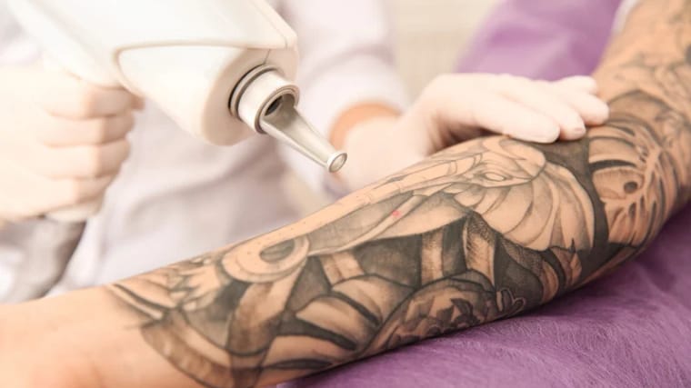 Tattoo Removal