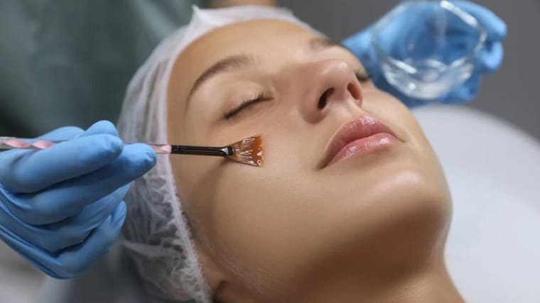 Chemical Peels