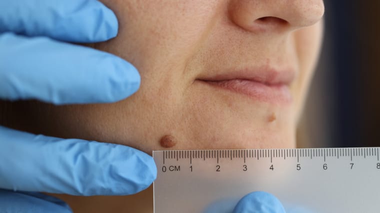 Warts, Skin tags & Mole Removal