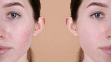 Acne & Acne Scars