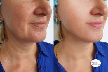 Benefits of Hydrafacial- Divine Skin Clinic