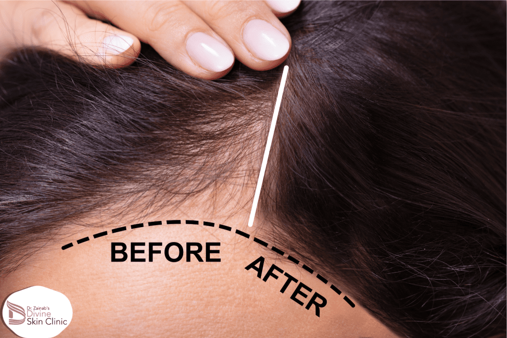 PRP Hair Treatment-Dr. Zainab Safderi