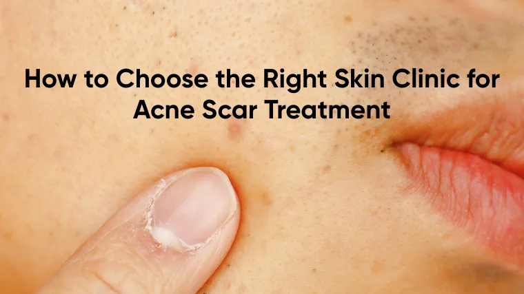 How to Choose the Right Skin Clinic for Acne Scar Treatment